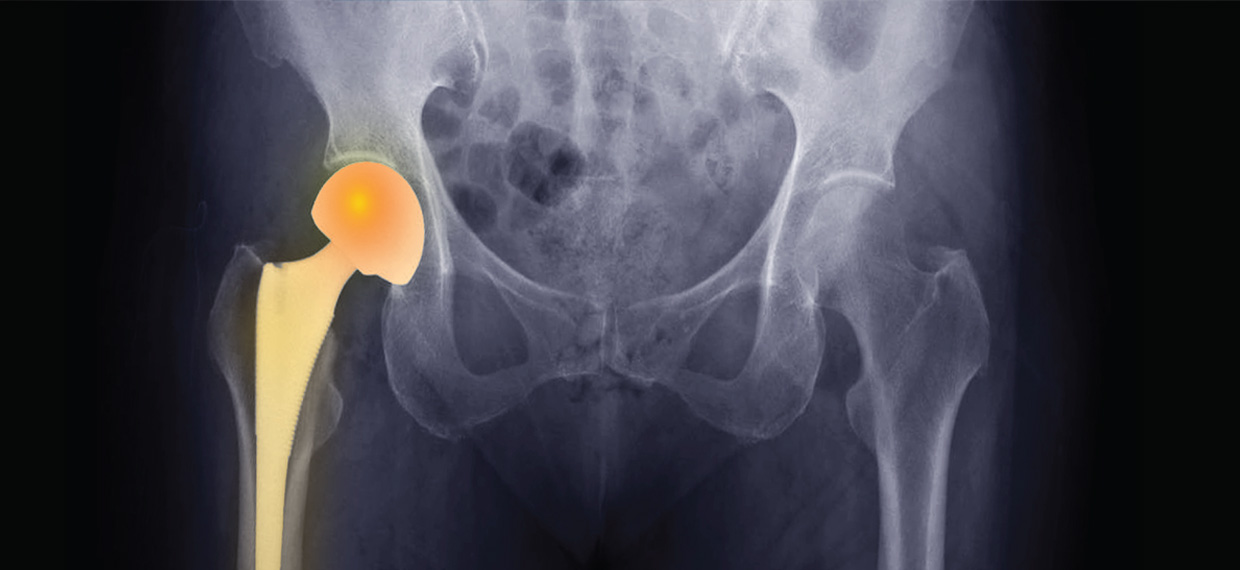 Que es una prótesis  de cadera